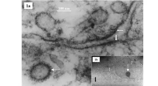Nipah Virus: The Deadly Threat Hidden in a Sweet Drink