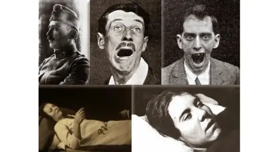 The Sleep That Didn’t End: How a Ghost Virus Turned 500,000 People into Living Statues